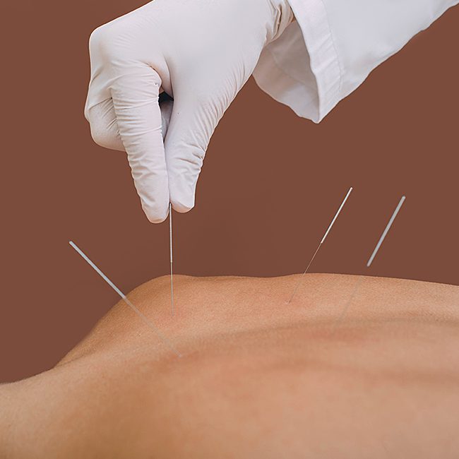 A person is acupuncture on the back of their body.